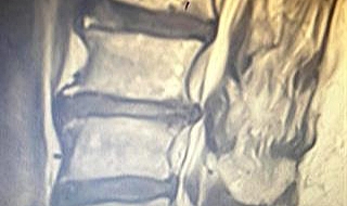 Belde Kanal Darlığı Tedavisinde Erken Teşhis Önem Taşıyor