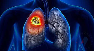 Akciğer kanserinin 8 önemli sinyali!