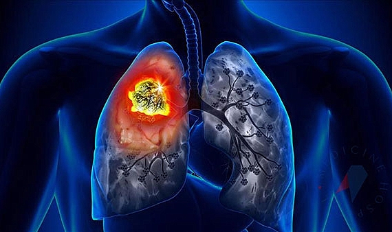 Akciğer kanserinin 8 önemli sinyali!