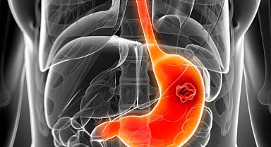 Mide kanseri belirtileri ülser ile karıştırılabilir 