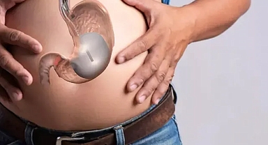 Mide botoksu ile ilgili 5 soru 5 cevap