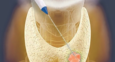 Girişimsel radyolojide uygulanan ameliyatsız işlemler nelerdir?
